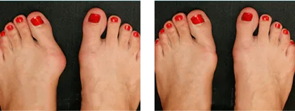 Valgus